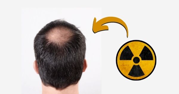 Can EMF Radiation Cause Hair Loss_